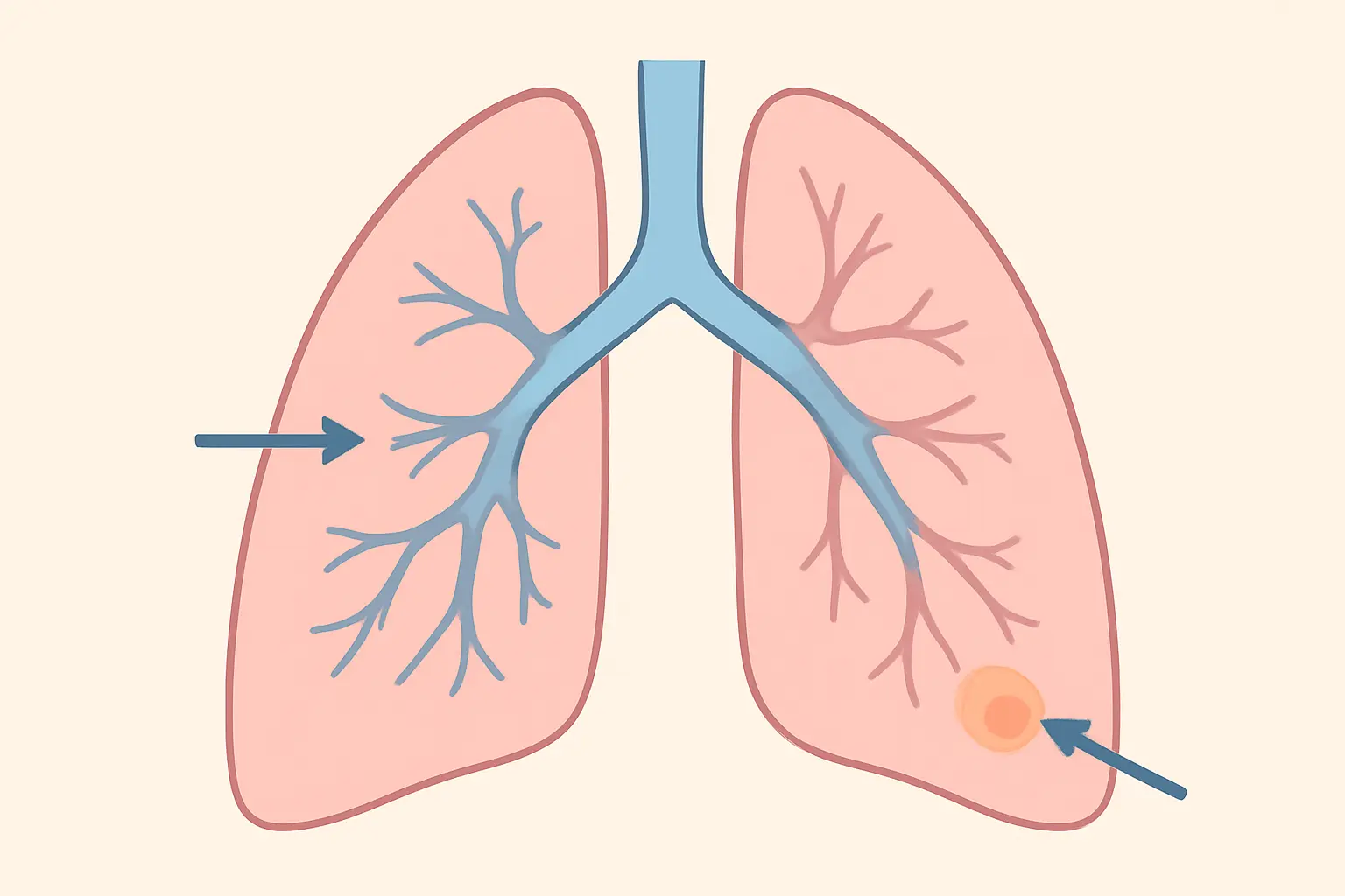 Illustration comparing a shallow puff reaching central airways with a deeper puff reaching peripheral lung tissue where adenocarcinoma develops
