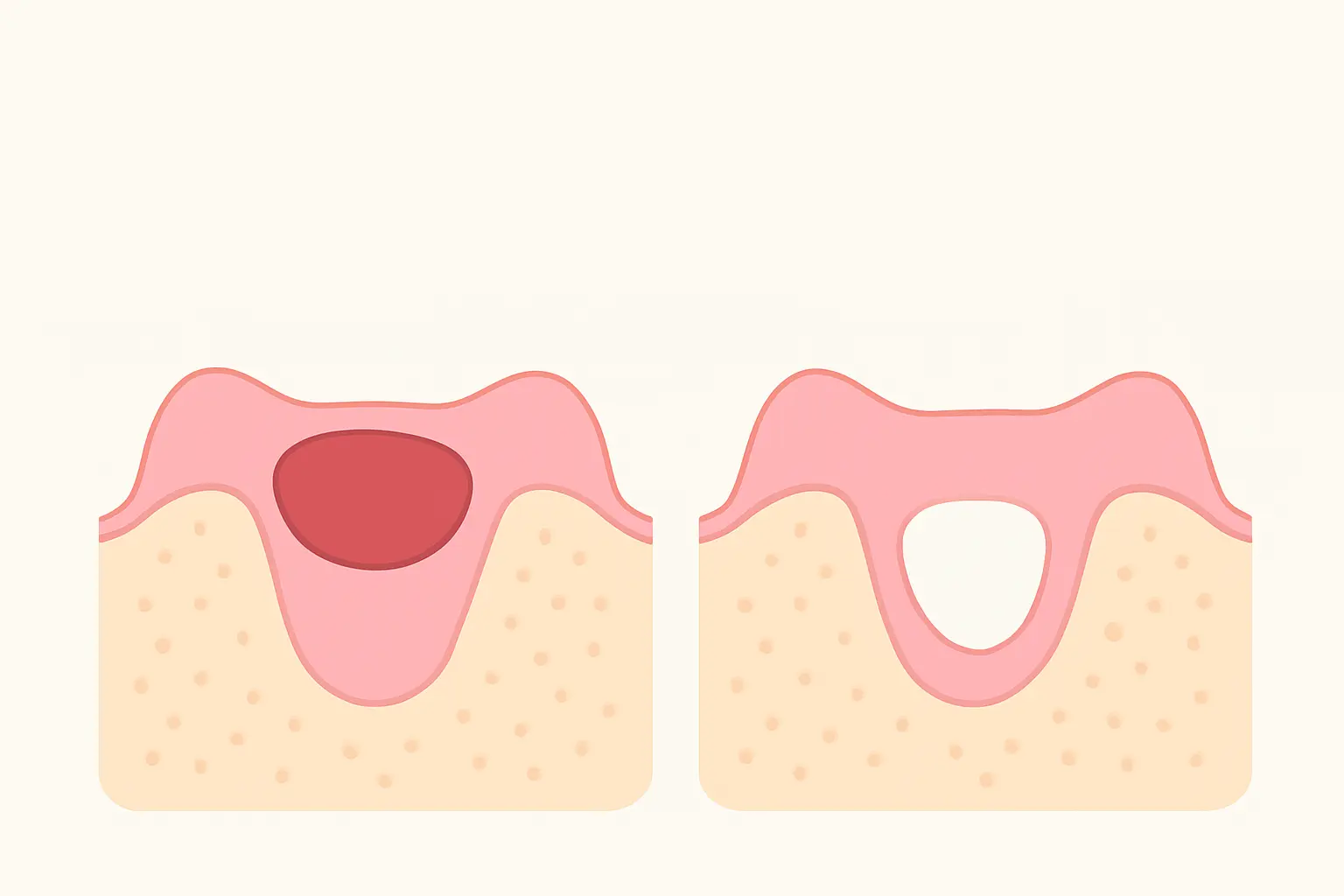 Illustration comparing a tooth socket with a protective blood clot against an empty exposed socket, showing what dry socket looks like