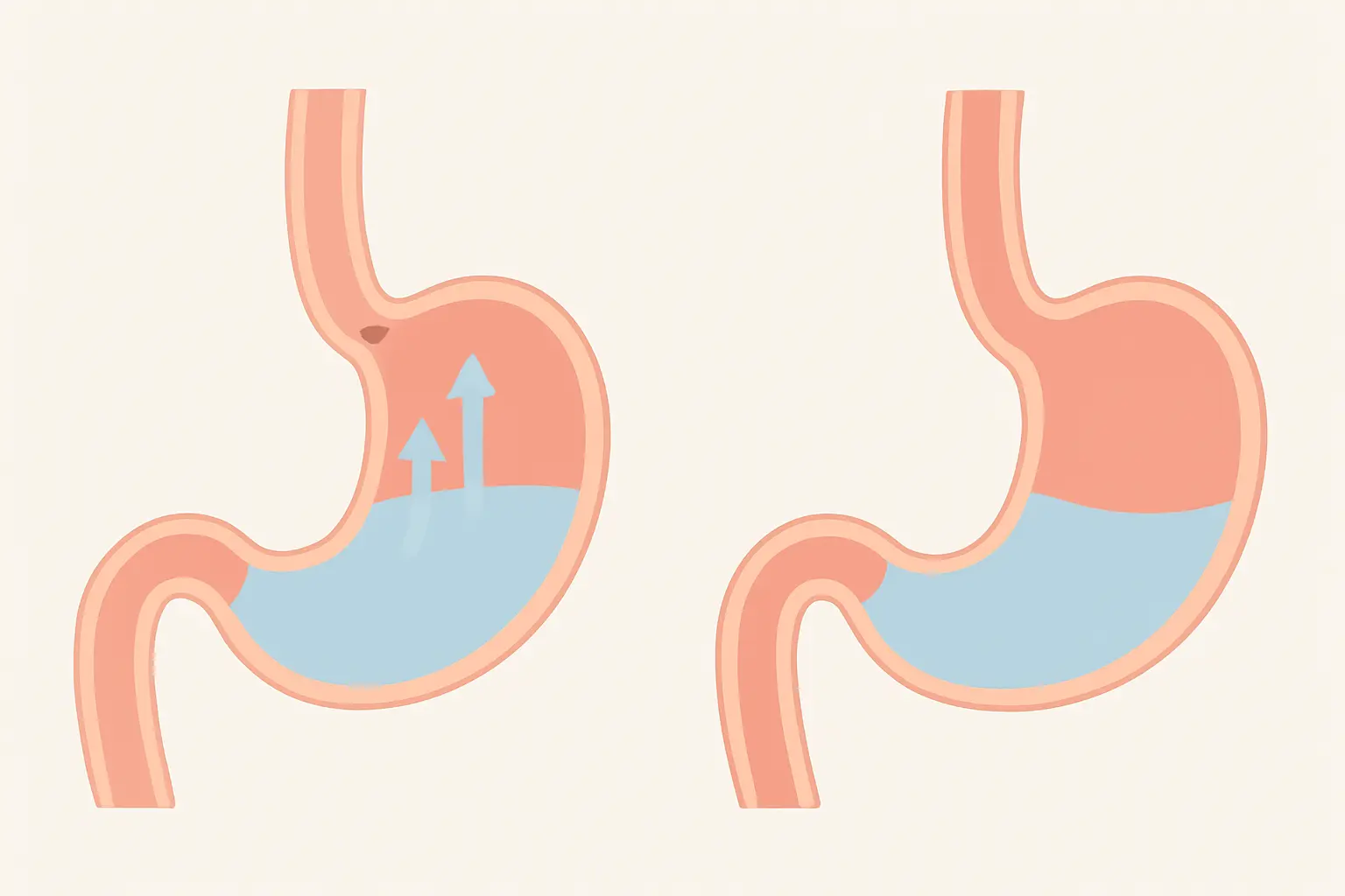 Illustration comparing a relaxed lower esophageal sphincter letting stomach acid rise with a closed sphincter holding it down