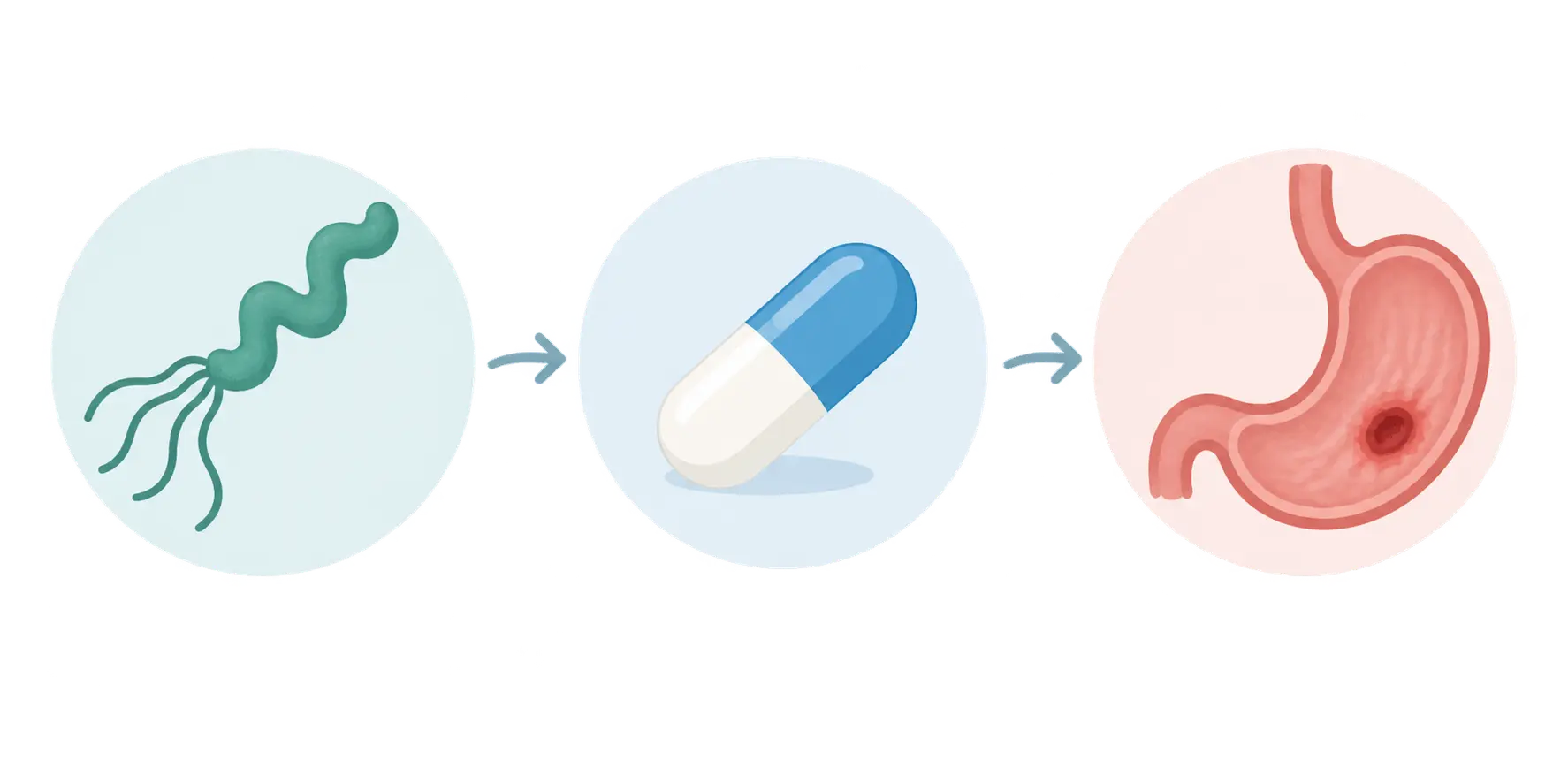 Illustration of a spiral bacterium, a pill and a stomach connected by arrows, representing causes and treatment of stomach ulcers